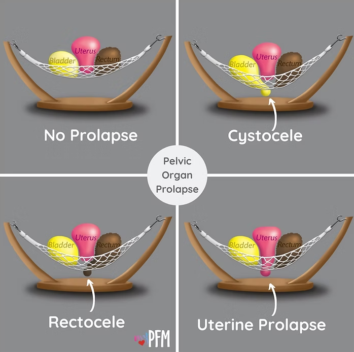 Vari tipi di prolasso degli organi pelvici. Fisioterapia del pavimento pelvico a Montebelluna, Rosà e Cavaso del Tomba